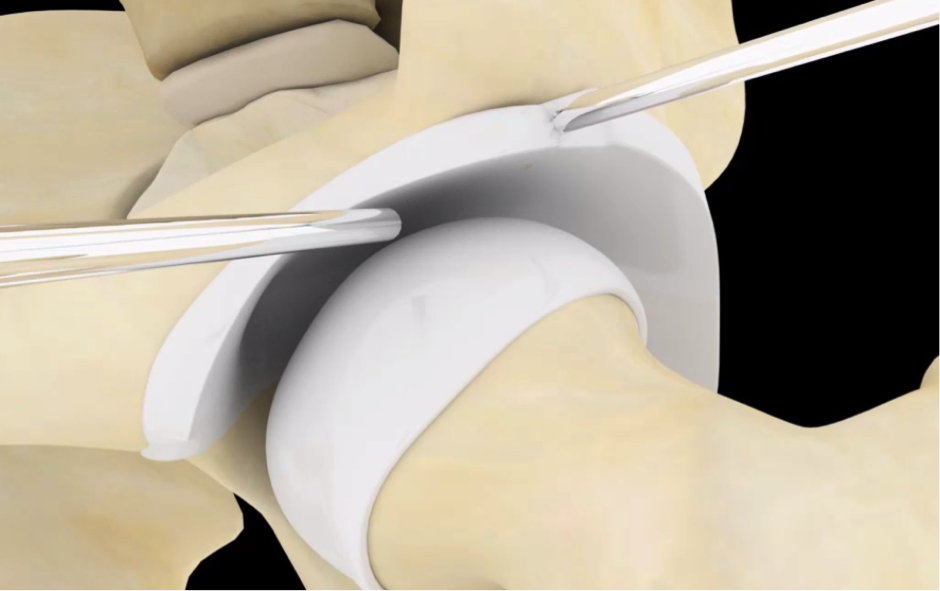 Arthroscopic surgery being visualized in 3-D animation
